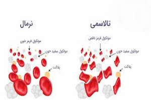 توصیه های تغذیه ای در تالاسمی